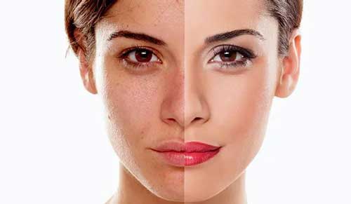 نمونه قبل و بعد از کربوکسی تراپی