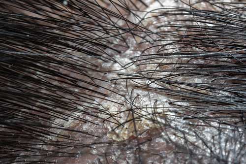 Dandruff Hair