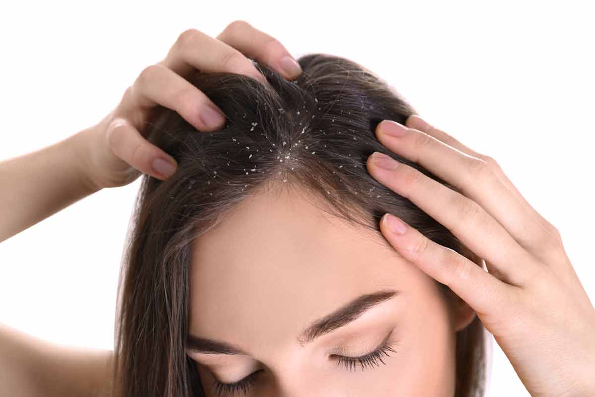عکس تزئینی خانم جوان دارای شوره سر