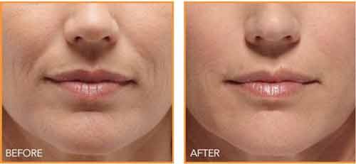 wrinkle treatment after before