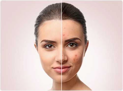 نمایش قبل و بعد از آرایش برای از بین بردن جوش