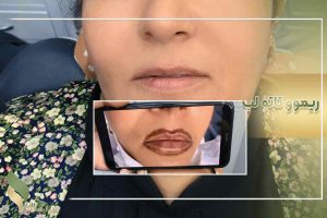 پاک کردن تاتو با ریموور