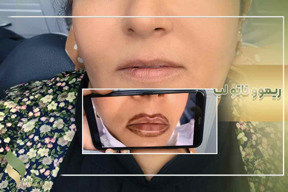 پاک کردن تاتو با ریموور
