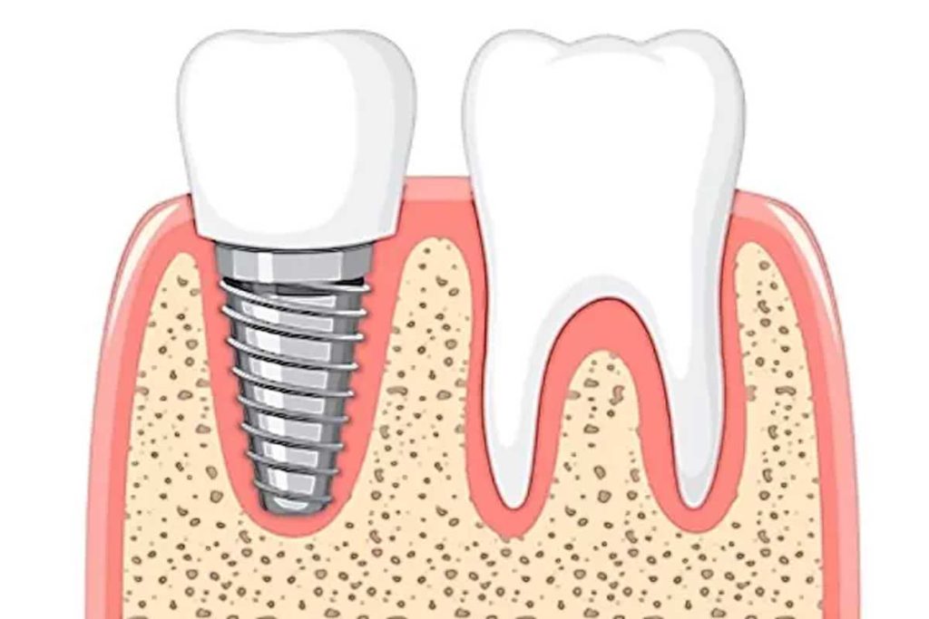 tooth implant cover