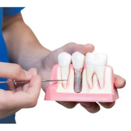 tooth implant1