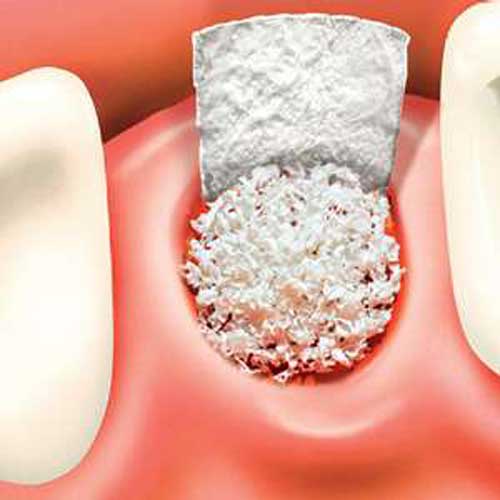 tooth implant2