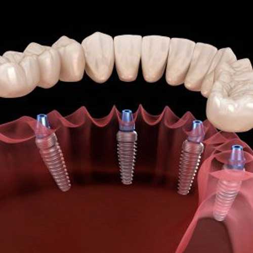 tooth implant3