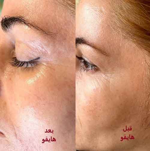 hifo before after