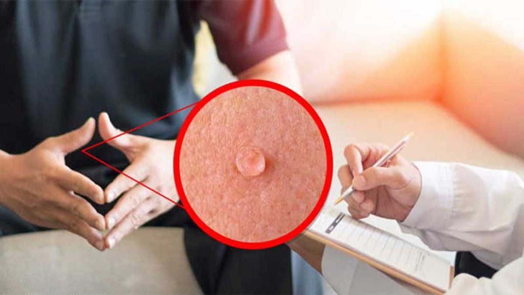 cryotherapy genital warts1