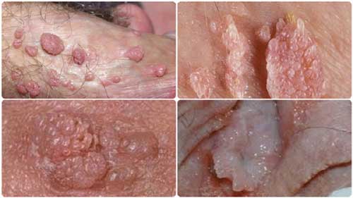 cryotherapy genital warts2
