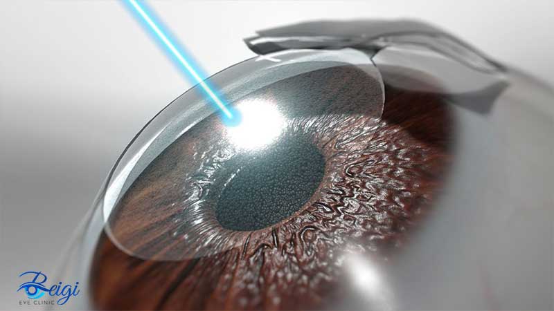 eye lasik2