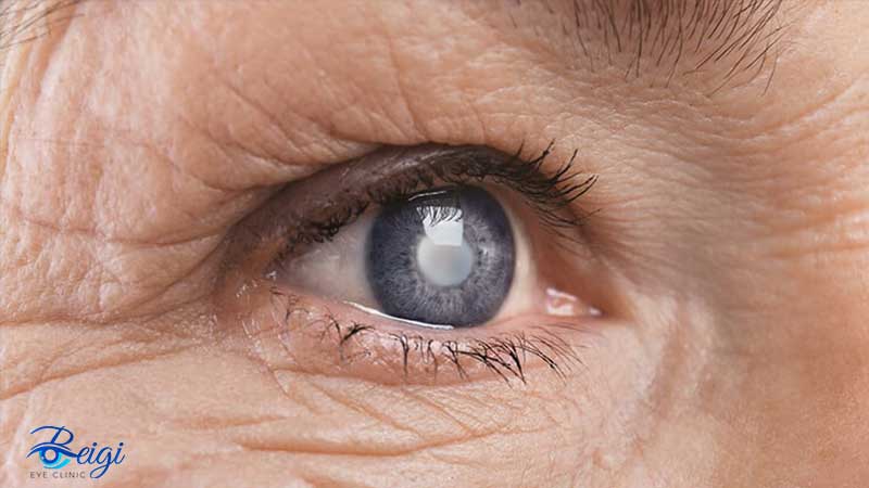eye lasik3