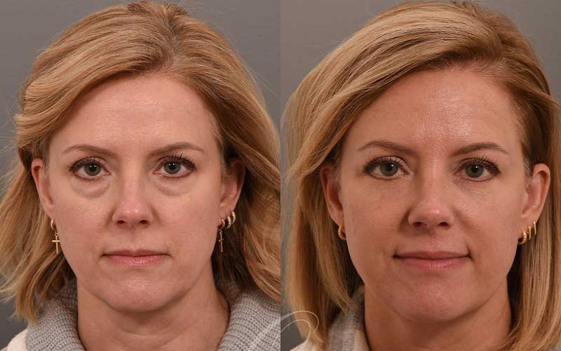 blepharoplasty vs