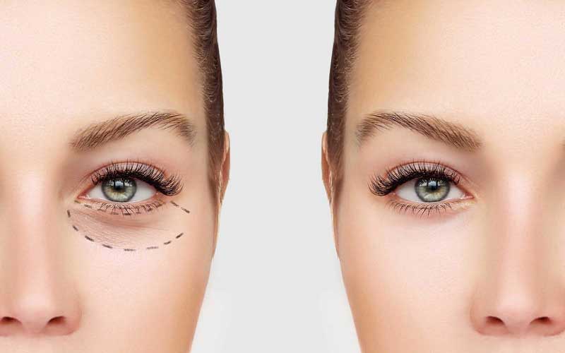 blepharoplasty vs